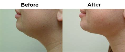 facial liposuction santa barbara|More.